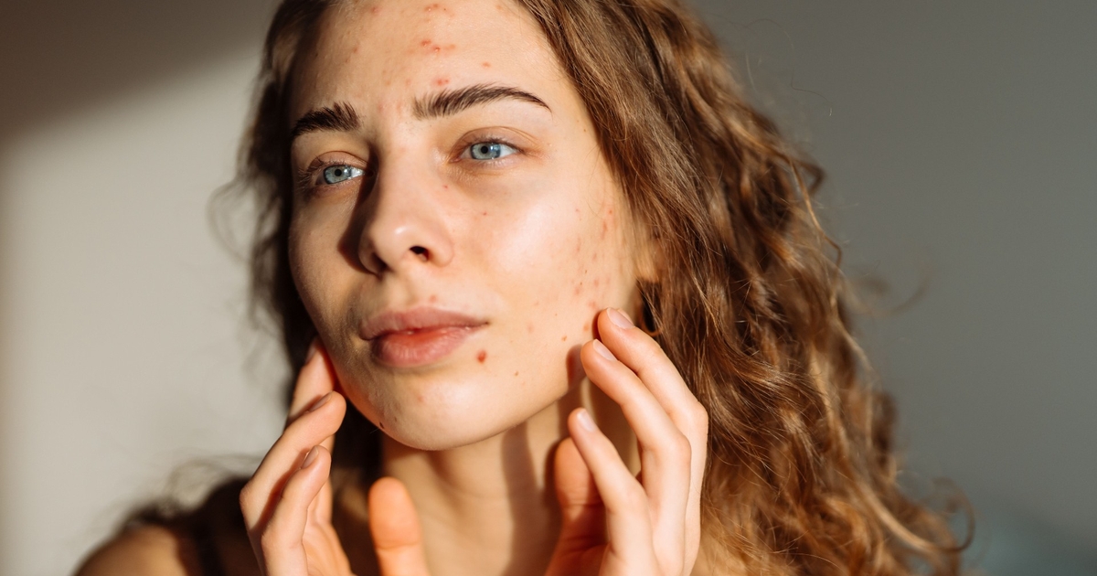 Ny studie visar Omega3 från alger kan lindra akne